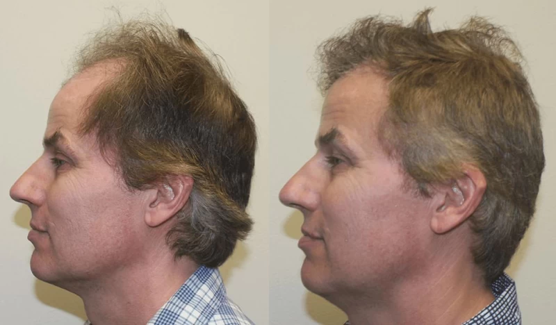 Patient p305 hair transplant before and after left view
