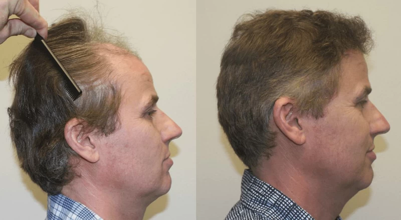 Patient p305 hair transplant before and after right view