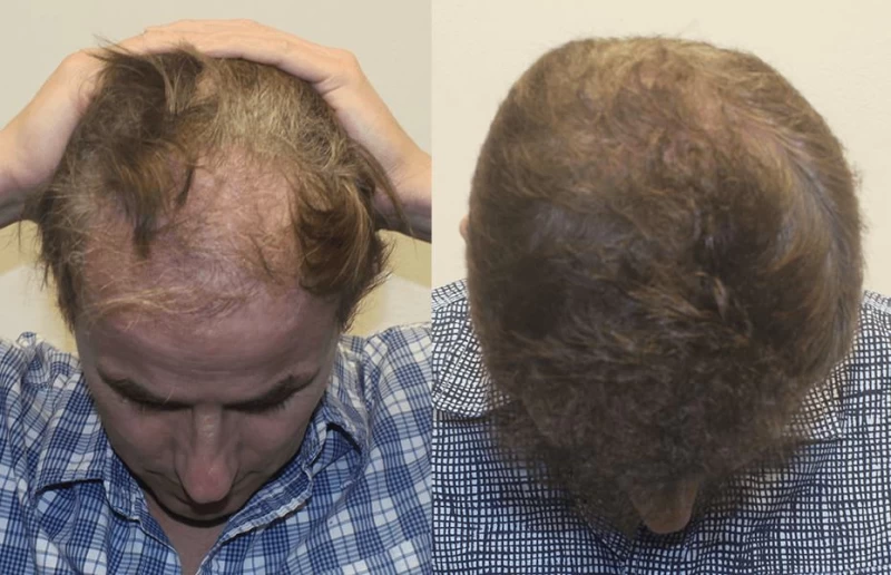Patient James corrective hair transplant results