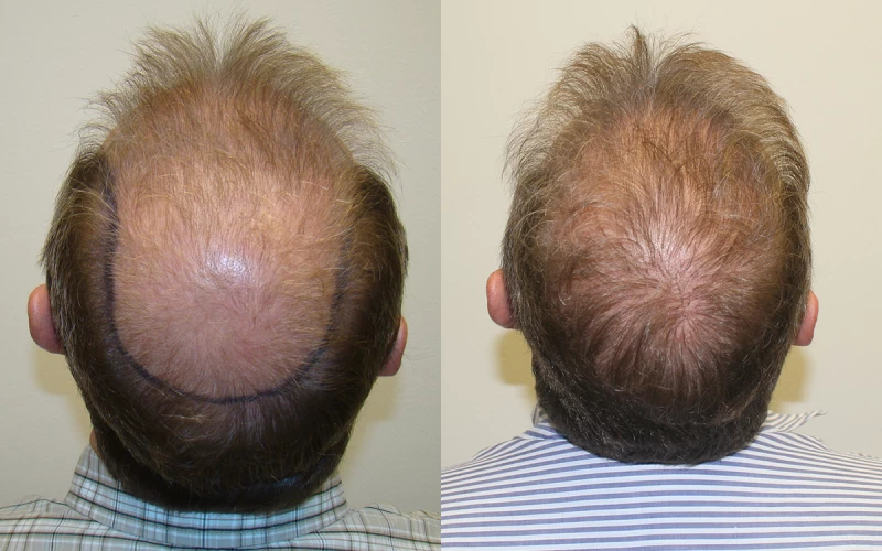 Patient p306 hair transplant before and after crown view