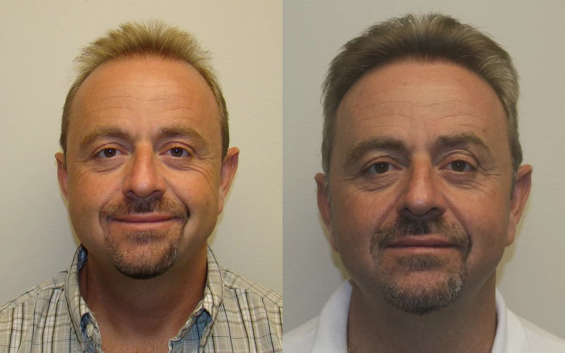 Anthony  Hair Transplant Before and After