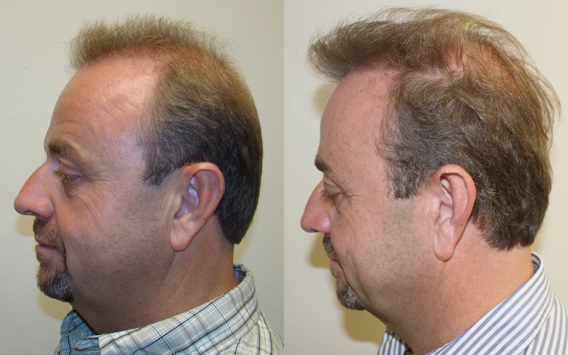 Patient p306 hair transplant before and after left view