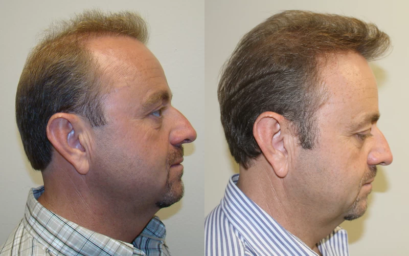 Patient p306 hair transplant before and after right view