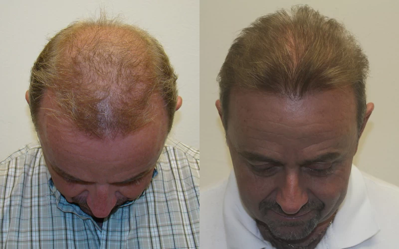 Patient p306 hair transplant before and after tilt view