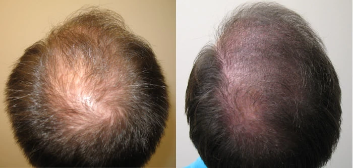 Patient p30 hair transplant before and after crown view