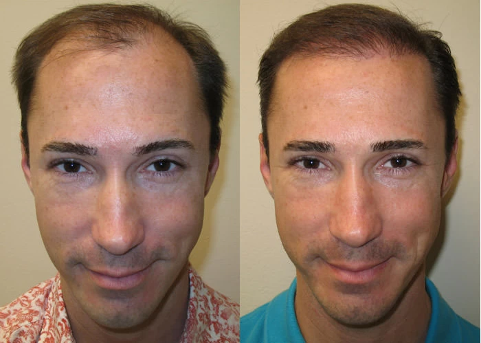 Chrystopher Hair Transplant Before and After