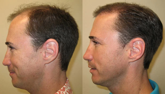 Patient p30 hair transplant before and after left view