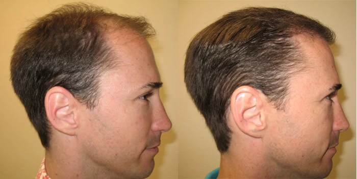 Patient p30 hair transplant before and after right view