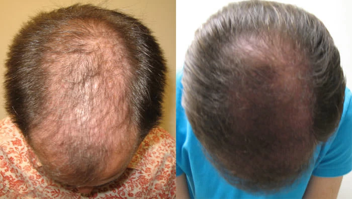 Patient p30 hair transplant before and after tilt view