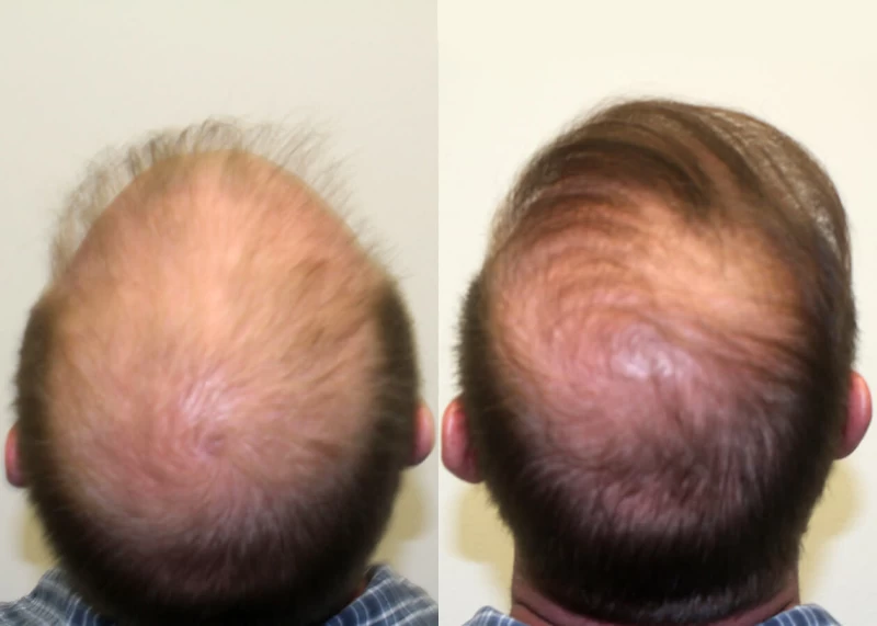 Patient p310 hair transplant before and after crown view