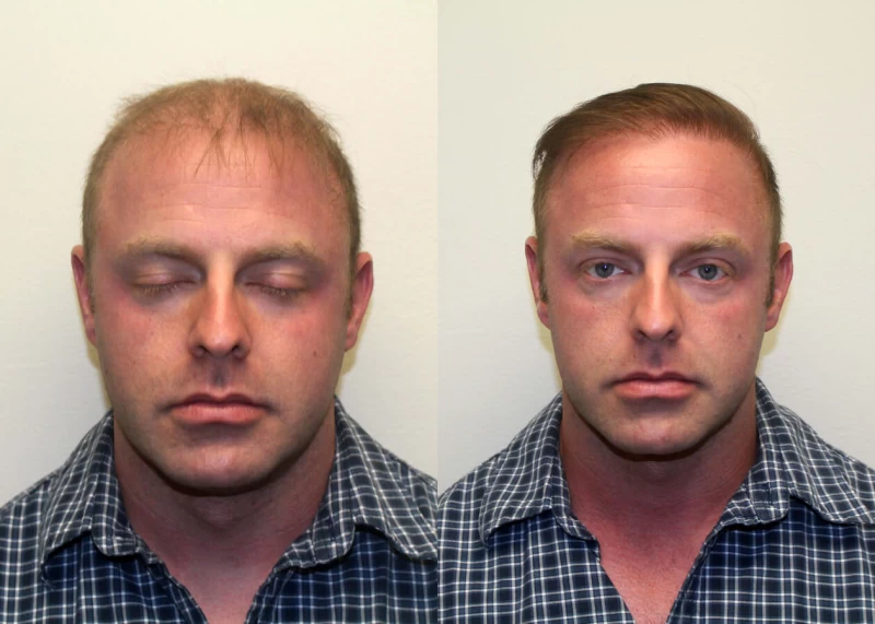 Jesse Hair Transplant Before and After