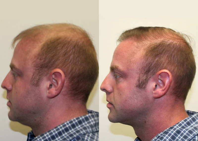 Patient p310 hair transplant before and after left view