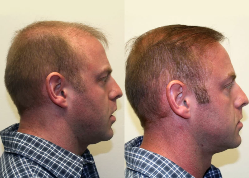 Patient p310 hair transplant before and after right view