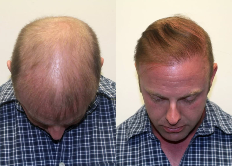Patient p310 hair transplant before and after tilt view