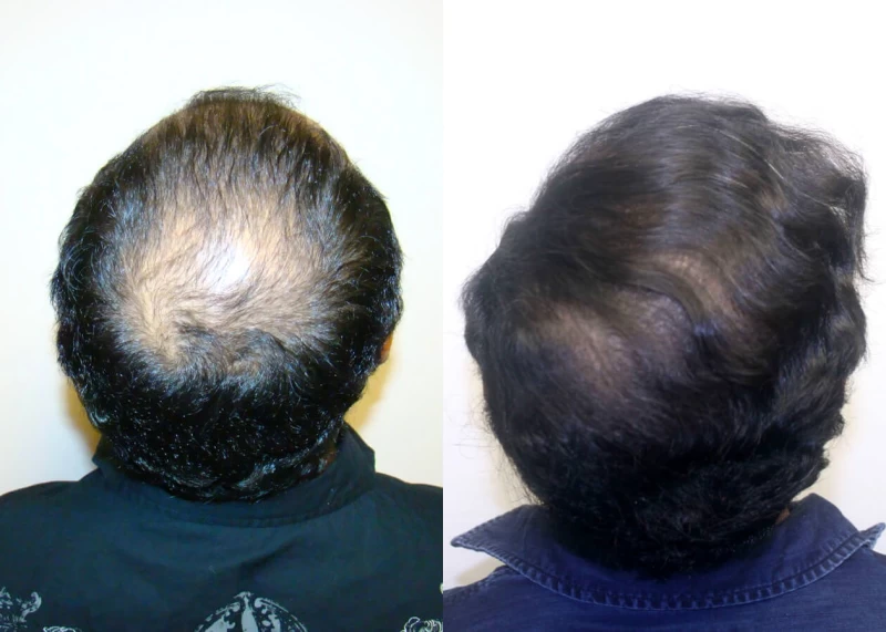 Patient p311 hair transplant before and after crown view