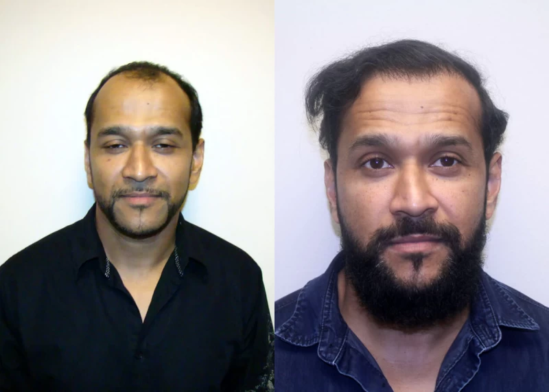 Sanjay Hair Transplant Before and After