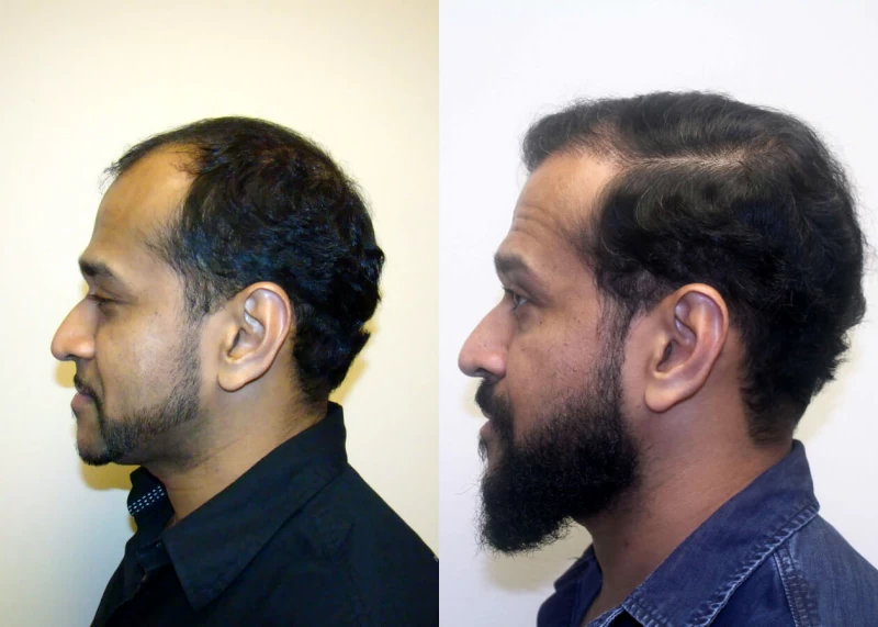 Patient p311 hair transplant before and after left view