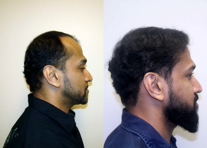 Patient p311 hair transplant before and after right view