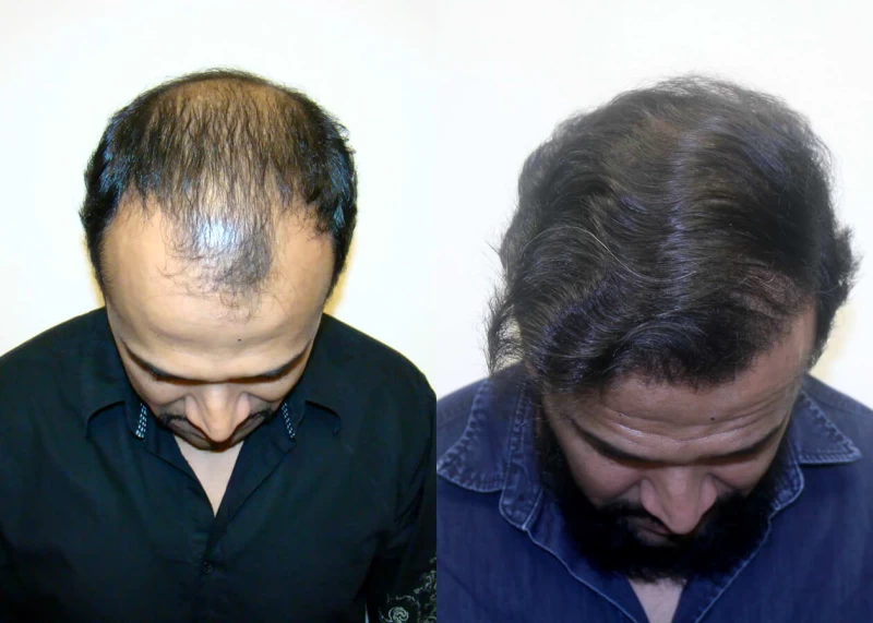 Patient p311 hair transplant before and after tilt view