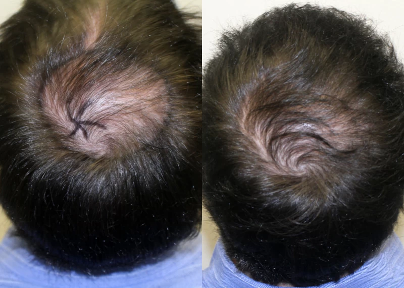 Patient p312 hair transplant before and after crown view