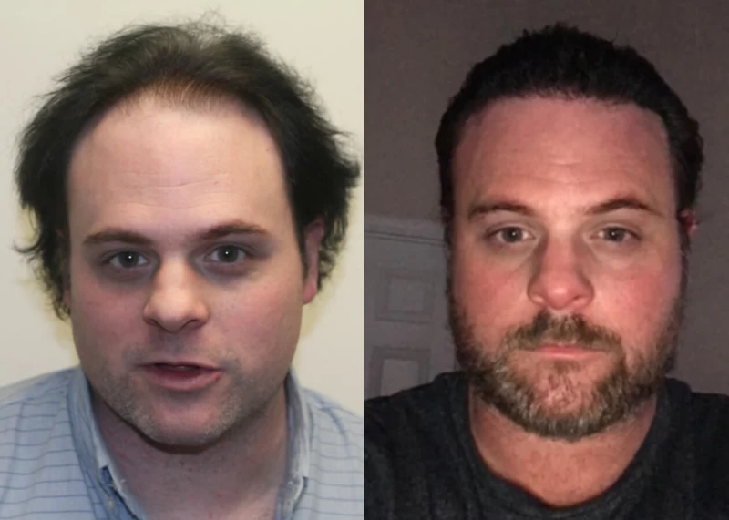 Tony Hair Transplant Before and After