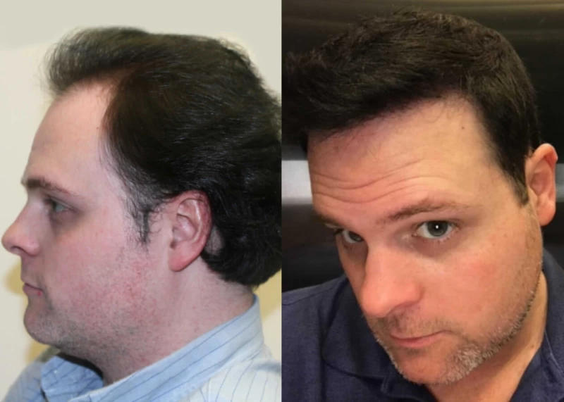 Patient p312 hair transplant before and after left view