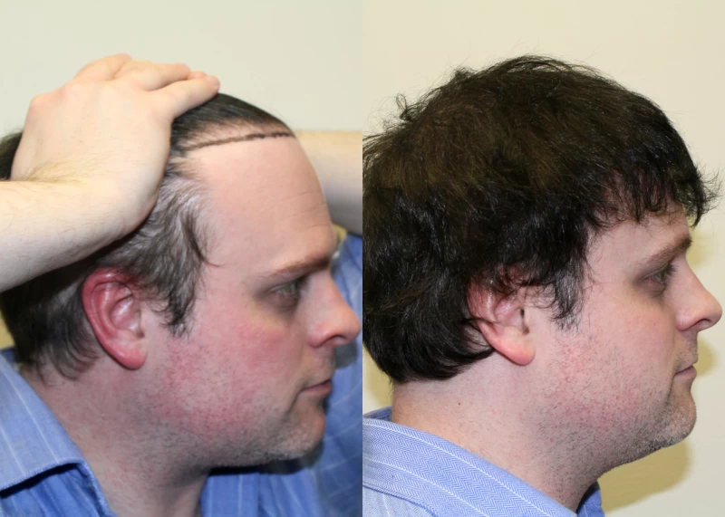 Patient p312 hair transplant before and after right view