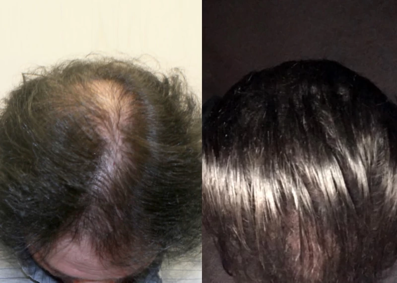 Patient p312 hair transplant before and after tilt view