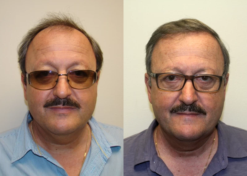 Peter  Hair Transplant Before and After