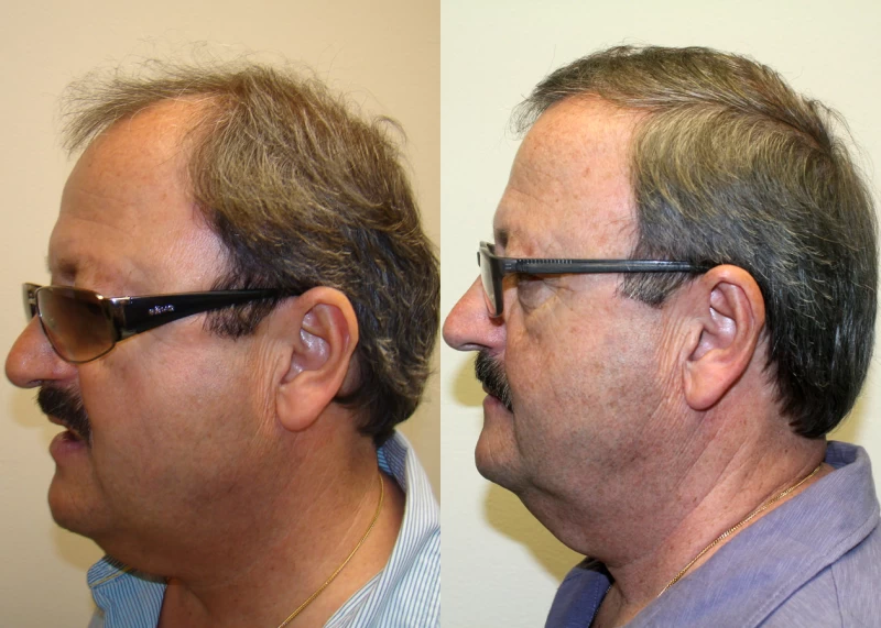 Patient p313 hair transplant before and after left view
