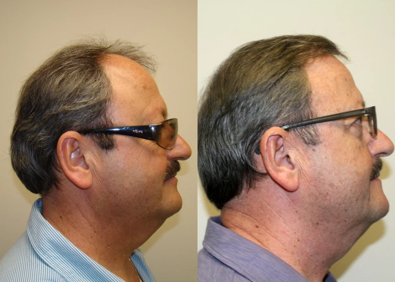 Patient p313 hair transplant before and after right view