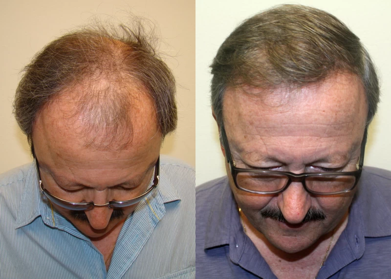 Patient p313 hair transplant before and after tilt view
