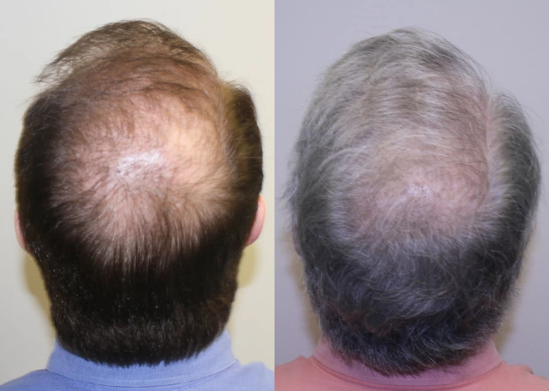 Patient p314 hair transplant before and after crown view