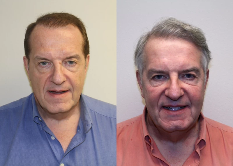 John Hair Transplant Before and After