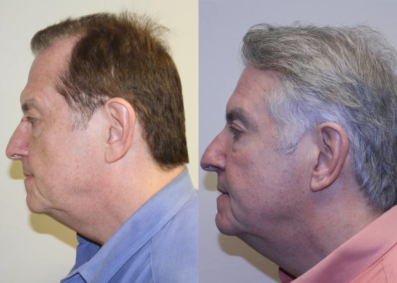 Patient p314 hair transplant before and after left view