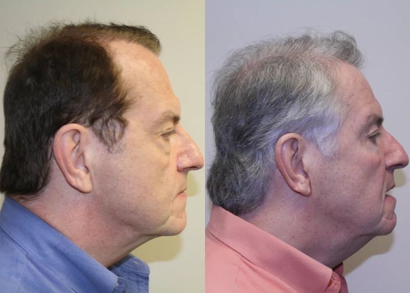 Patient p314 hair transplant before and after right view