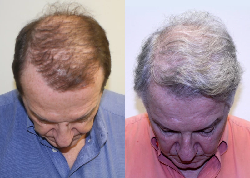 Patient p314 hair transplant before and after tilt view