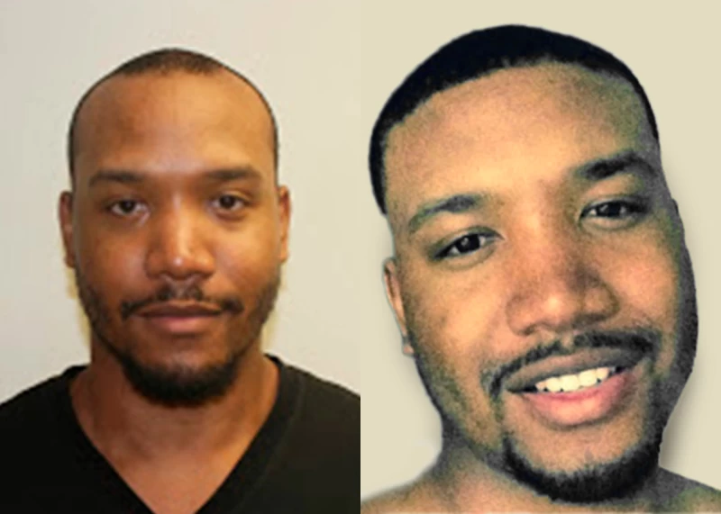 Patient 315 Hair Transplant Before and After