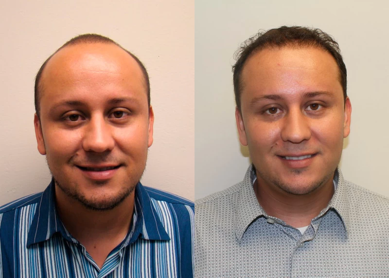 Patient 316 Hair Transplant Before and After