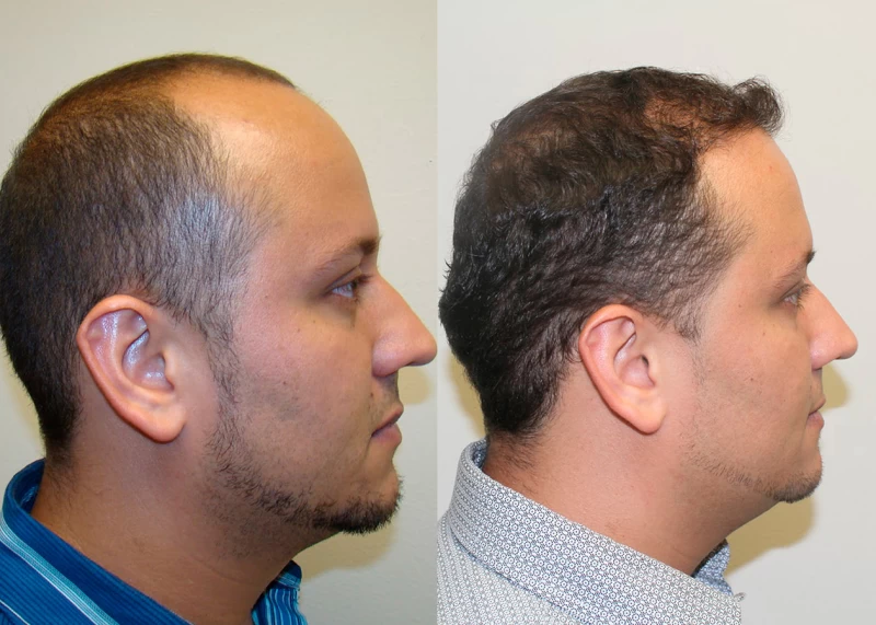 Patient p316 hair transplant before and after right view