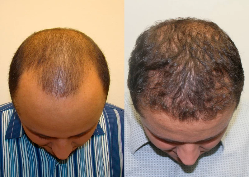 Patient p316 hair transplant before and after tilt view