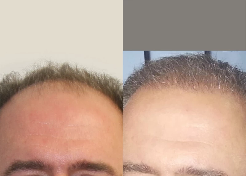 Patient 317 Hair Transplant Before and After