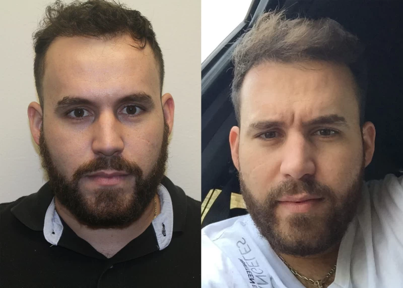 Patient 318 Hair Transplant Before and After