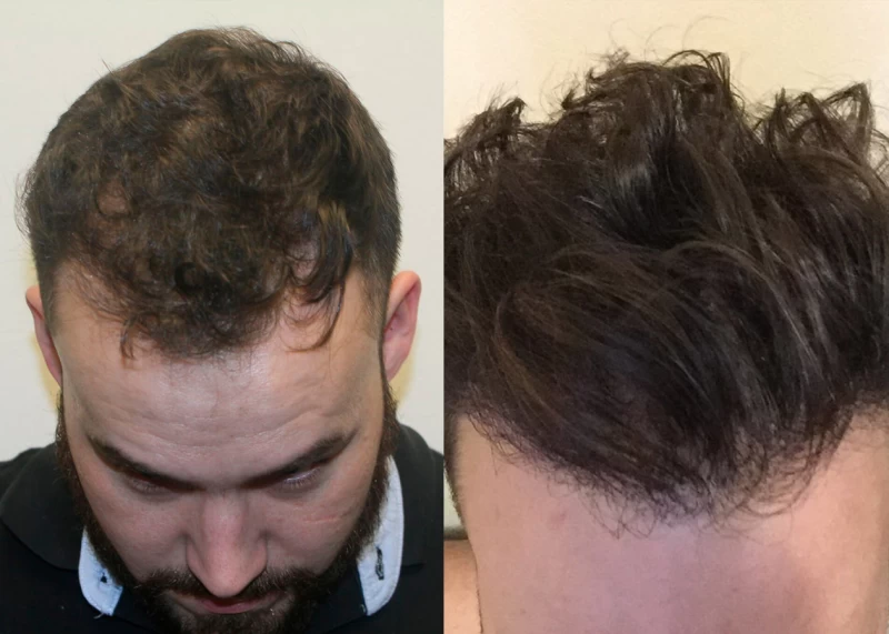 Patient p318 hair transplant before and after tilt view