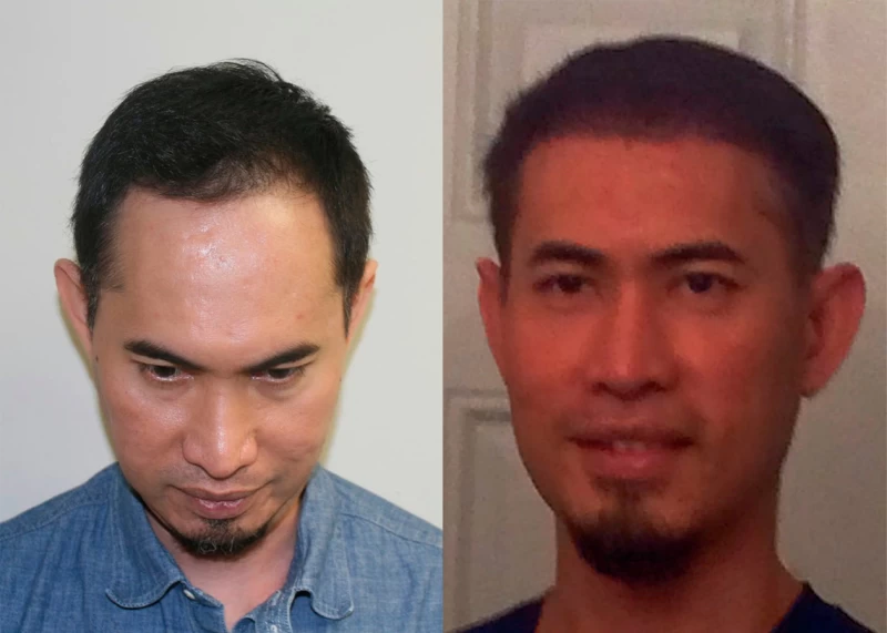 Patient 319 Hair Transplant Before and After