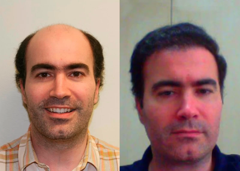 Patient 320 Hair Transplant Before and After