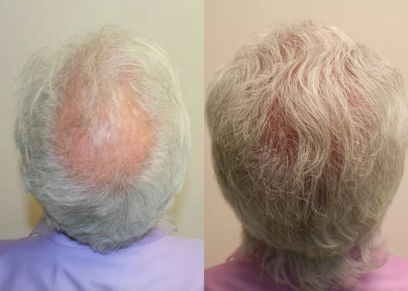 Patient 321 Hair Transplant Before and After