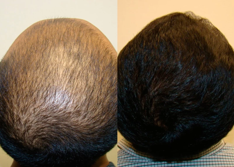 Patient 322 Hair Transplant Before and After