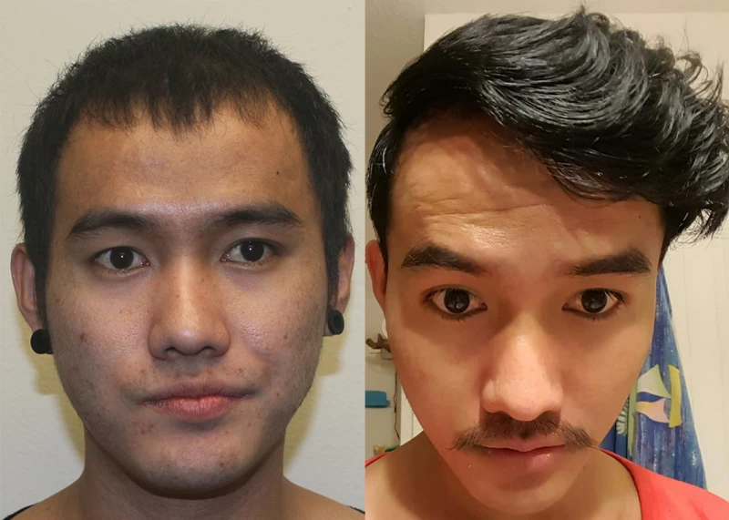 Patient 323 Hair Transplant Before and After