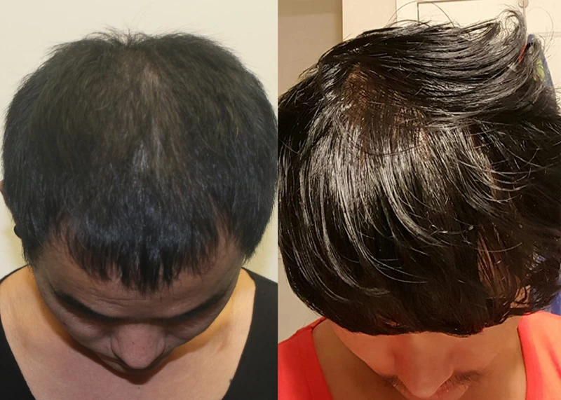 Patient p323 hair transplant before and after tilt view